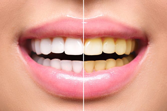 Hábitos que podem deixar os dentes amarelos
