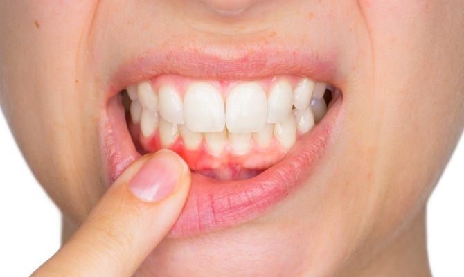 Recobrimento Radicular: uma técnica da plástica periodontal