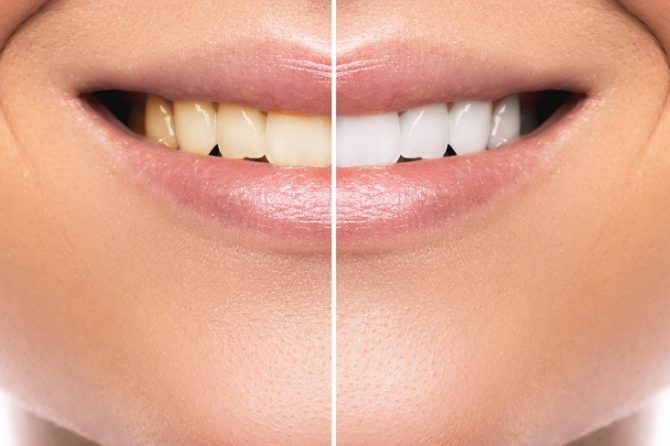 Clareamento Dental – quando fazer?