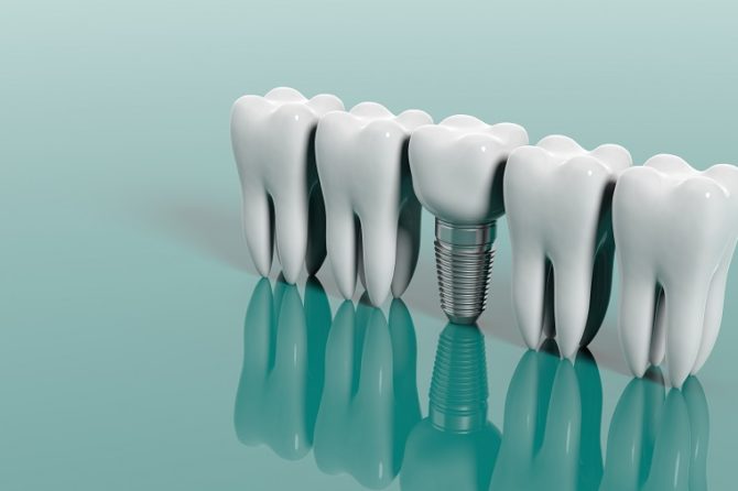 Implante Dental em Poços de Caldas